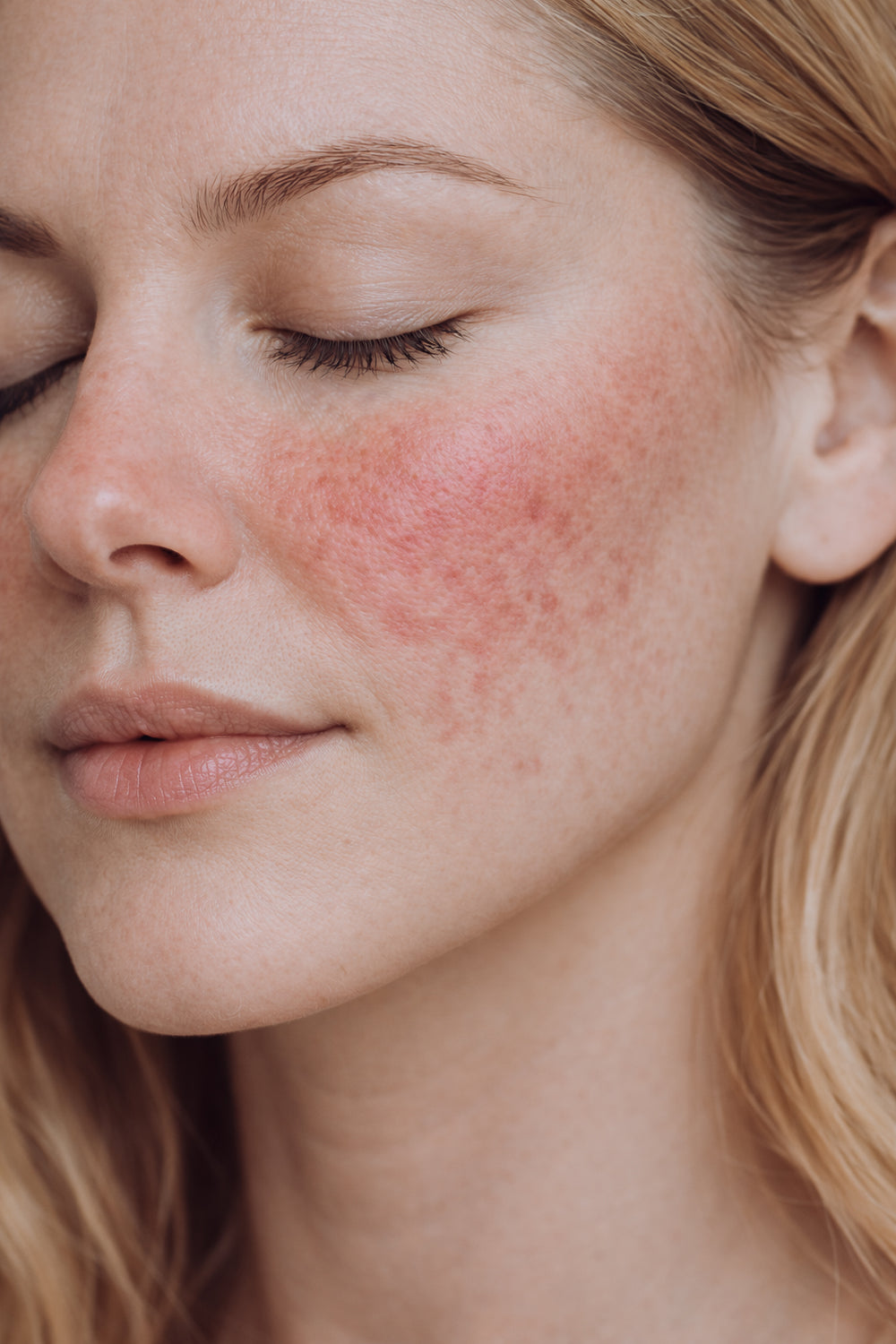 What is Rosacea?