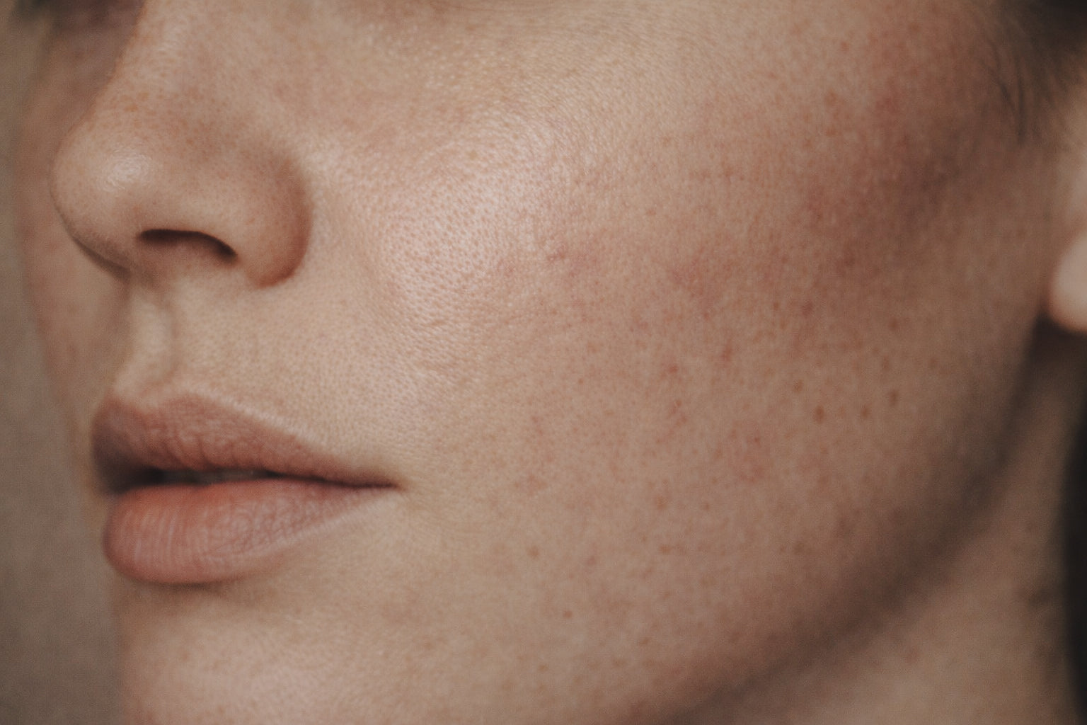 SkinPen® Microneedling