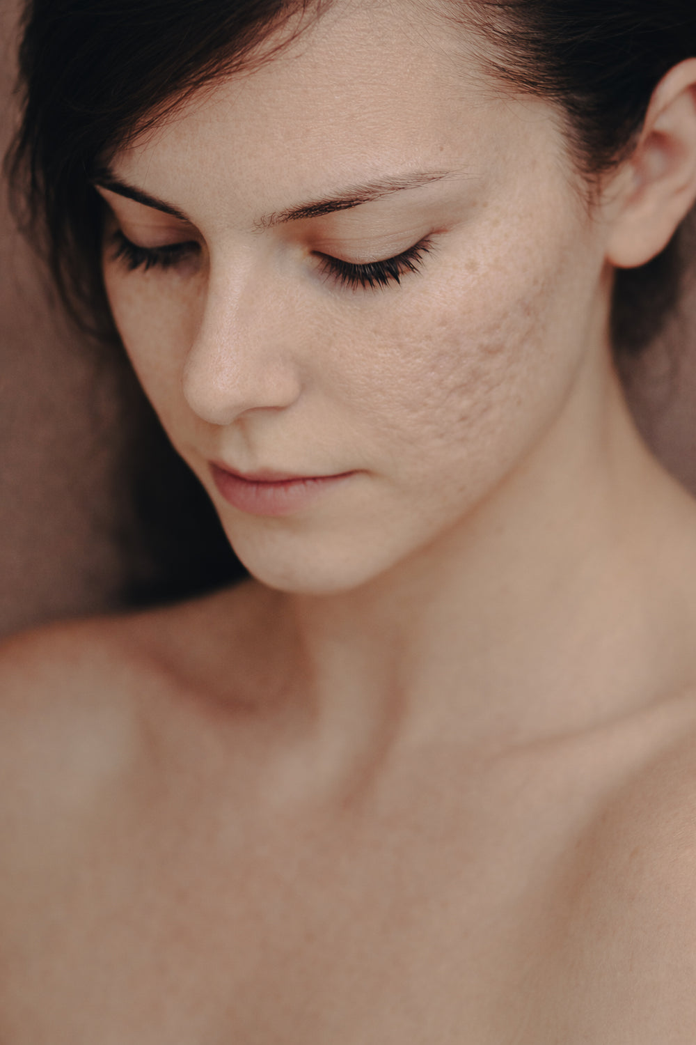 What is Atrophic Acne Scarring?