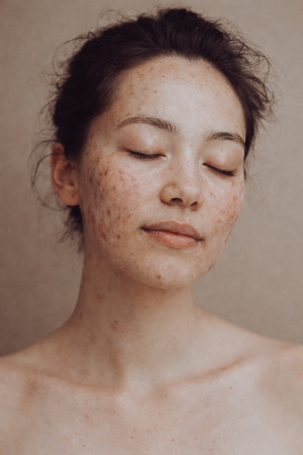 Acne & Scarring